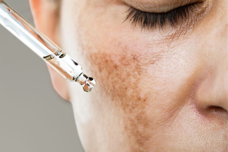 Hydrafacial Behandlung in der glow up clinic in Hannover